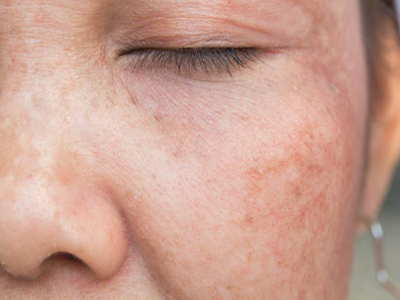 Sun and age damaged skin